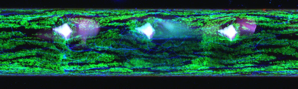 Postrun Stenosis Collagen Scan JCSMR